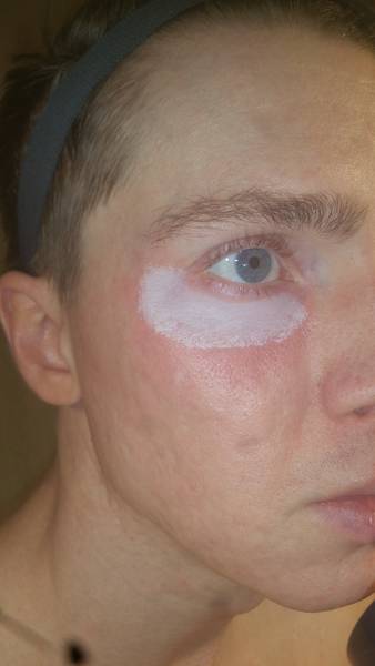 acné rosacée comment calmer