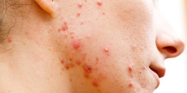 acne huile jojoba ou noisette