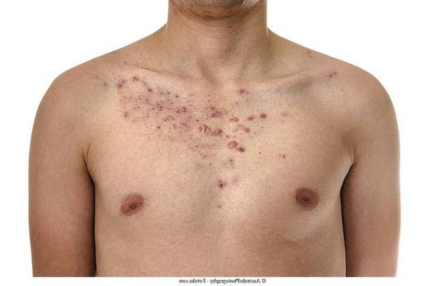 bouton acné qui sent mauvais