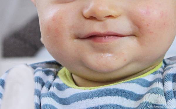 acne huile jojoba ou noisette