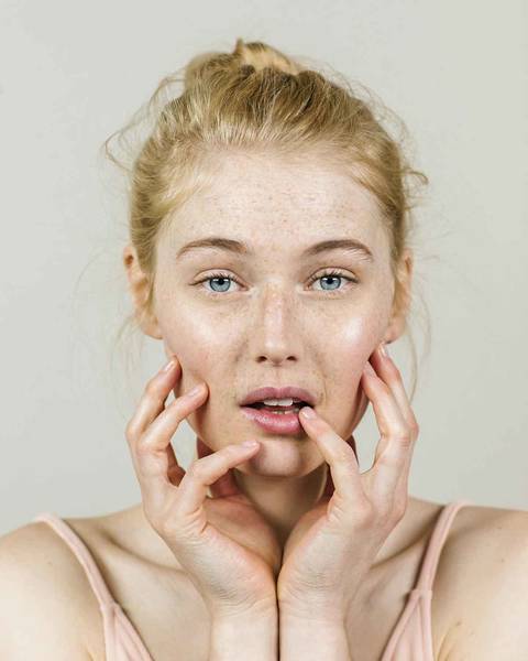 acne ou eczema nourrisson