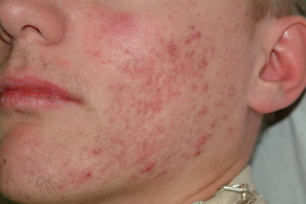 traitement acné peau qui pèle