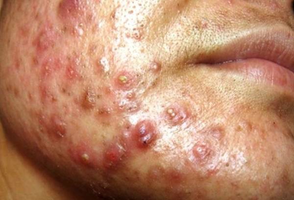 ou acheter du zinc pour acné