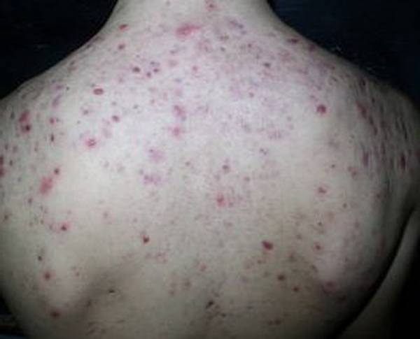 quelle crème anti acné