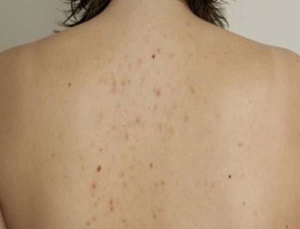 comment traiter les cicatrices d acné