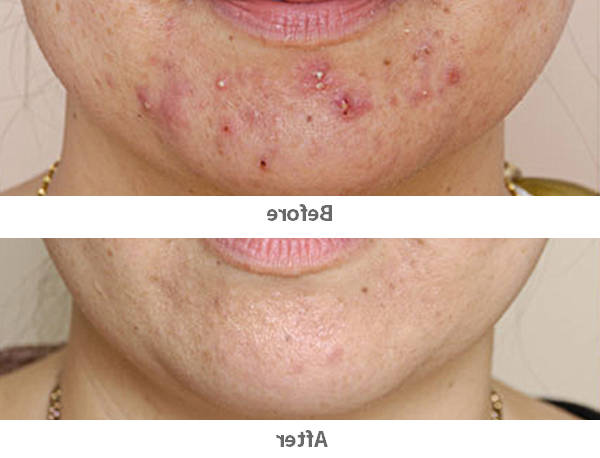 quelle huile végétale pour acné