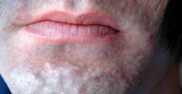 acne severe comment s en débarrasser