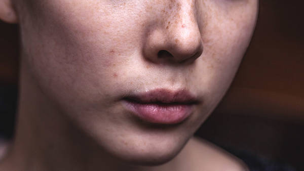 comment traiter acné naturellement