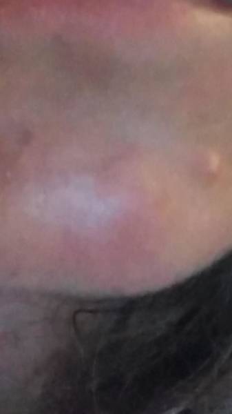 pourquoi acne