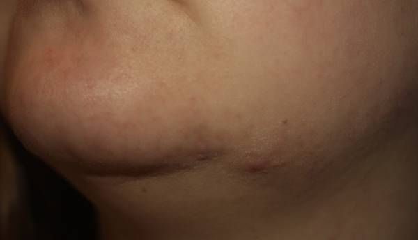 quelle pilule anti acné