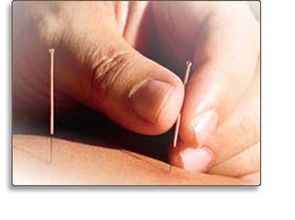 acupuncture migraine