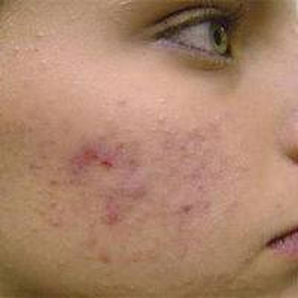 et pourquoi pas coline acné