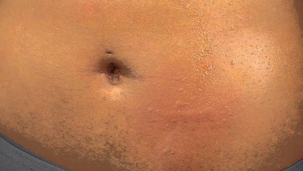 grossesse et acné dans le dos fille ou garcon