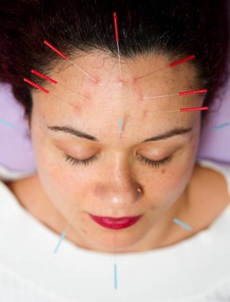 acupuncture laser