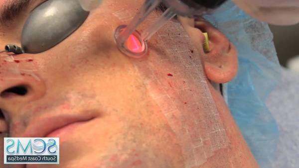 quelle pilule contre l acné