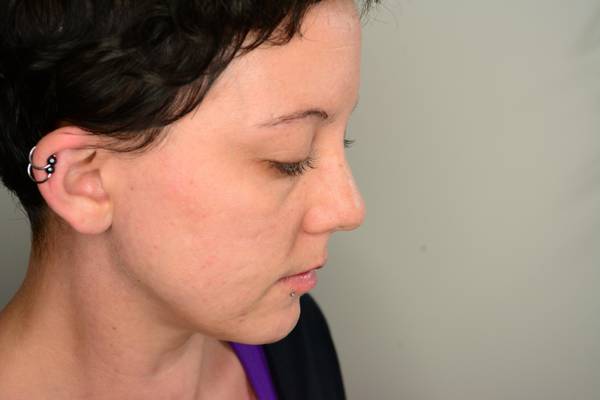 comment masquer bouton acné