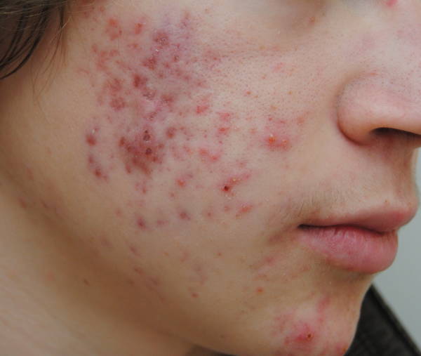 comment reconnaitre acné hormonal