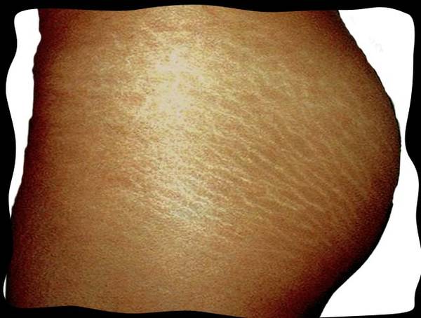 grossesse et acné visage fille ou garçon