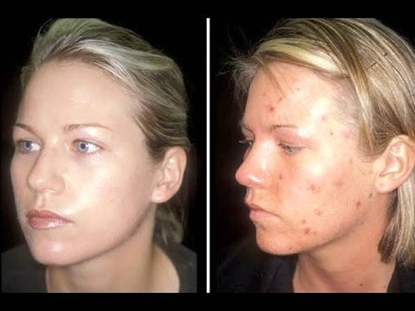 comment traiter acné du nourrisson