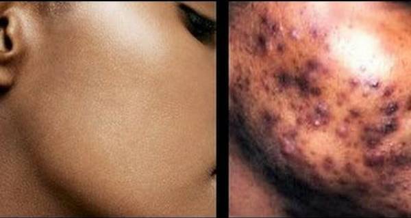 comment ne plus avoir d acné rapidement