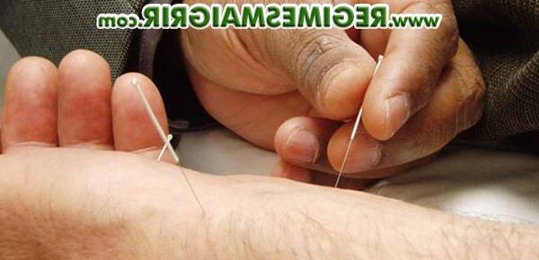 acupuncture témoignage