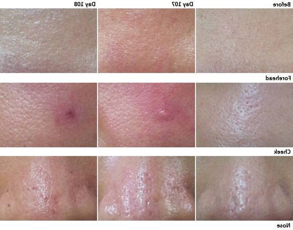 acné peau qui pèle