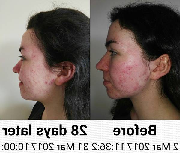 acné hormonale qui consulter