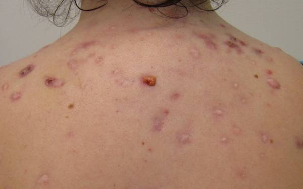 comment faire disparaitre boutons acné