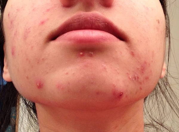 comment reconnaitre acné hormonale