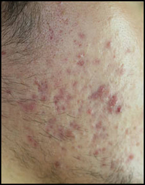 comment enlever trace rouge acne