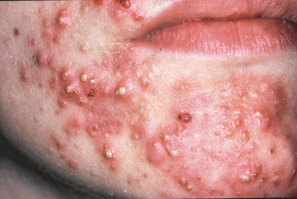 acne comment nettoyer sa peau