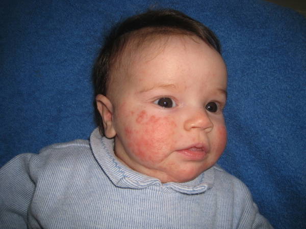 quand s arrete l acné