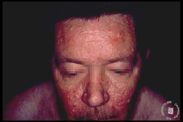 pilule contre l acné qui ne fait pas grossir