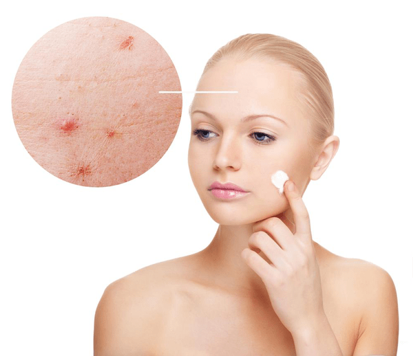 acne ou eczema nourrisson
