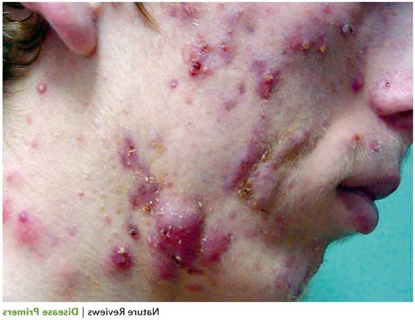 comment percer un kyste acné