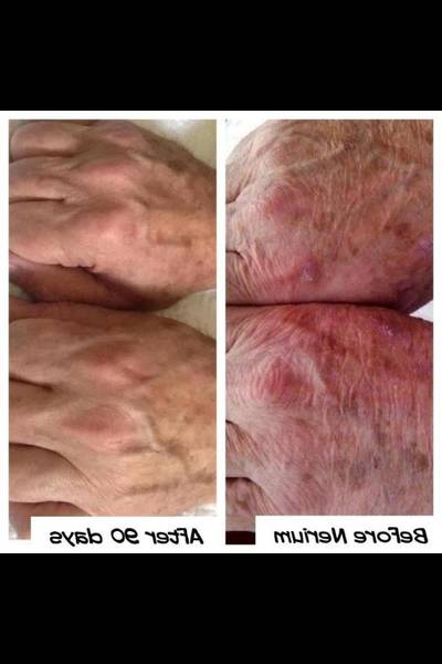 comment diminuer l acné