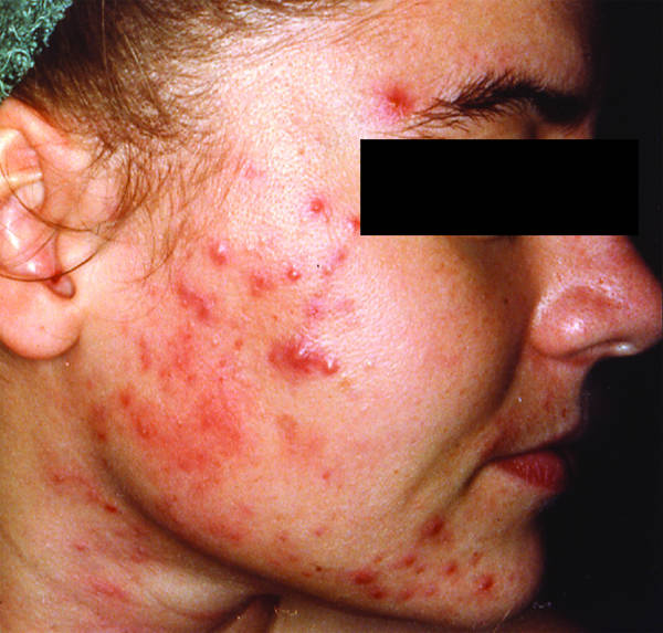 acne hormonale qui consulter