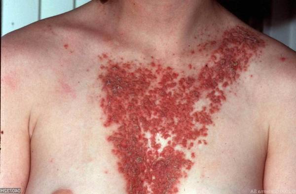 quelle huile essentielle pour acne