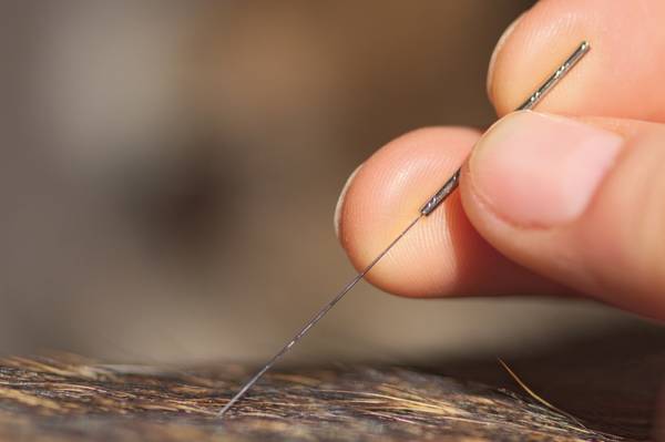 acupuncteur lille avis