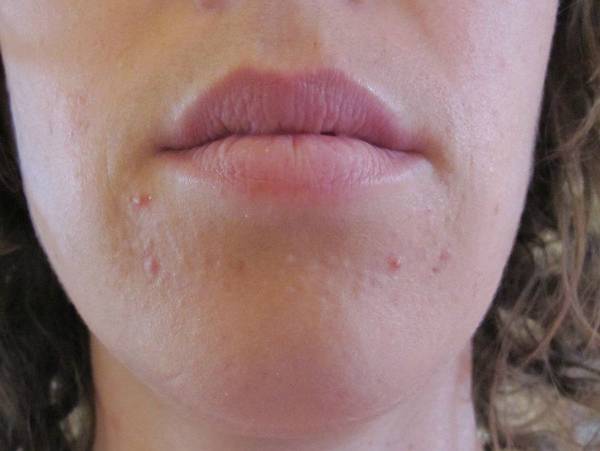 acne ou herpes labial