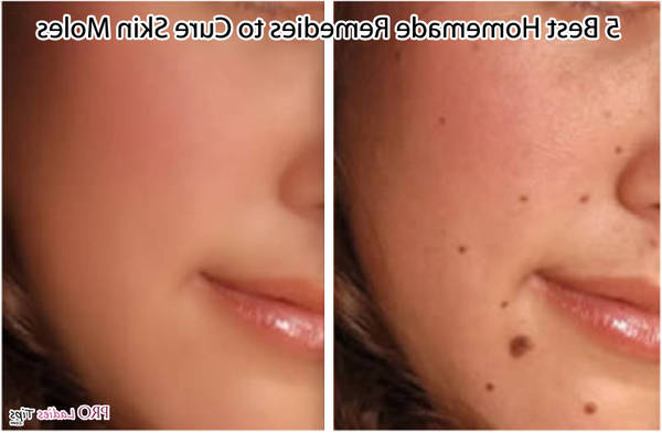 pourquoi acne adulte