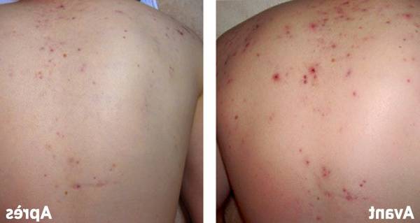 aliments qui donnent acné