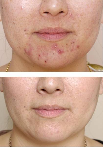 comment faire pour ne plus avoir d acné