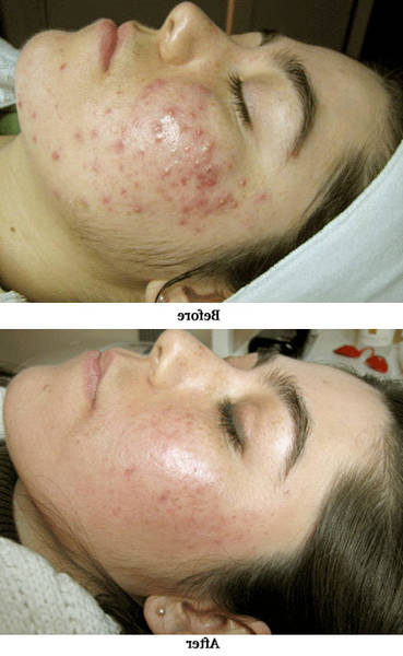 comment attenuer cicatrice acne