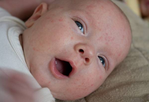 acné jasmine ou diane