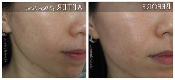 comment enlever les cicatrices d acné