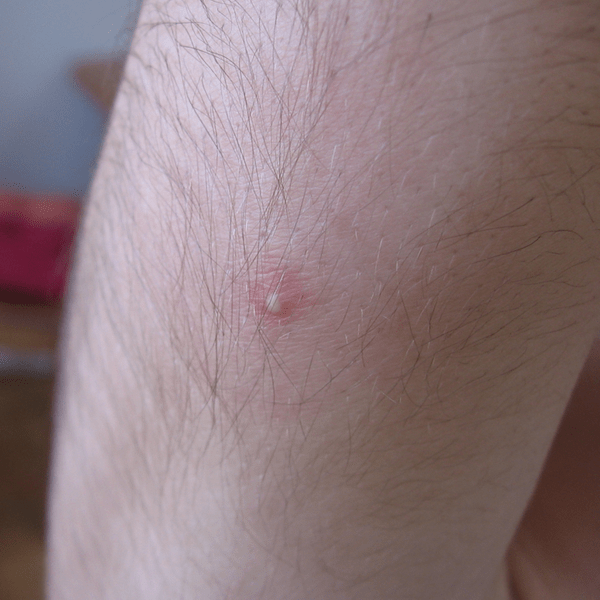 boutons acne qui grattent