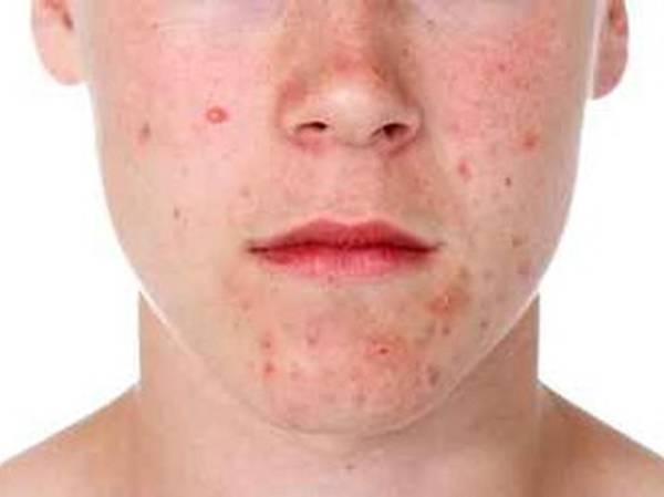 fond de teint anti acné elf quelle teinte