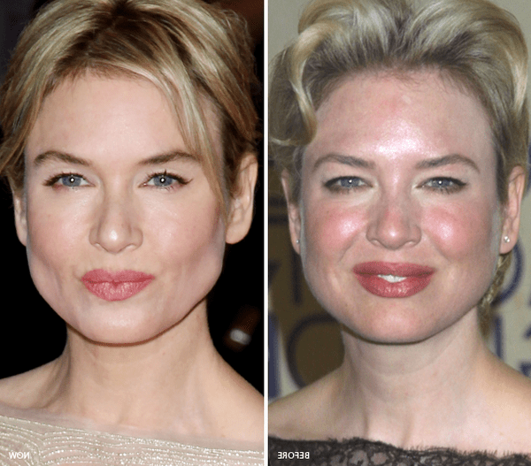 bouton acné comment enlever