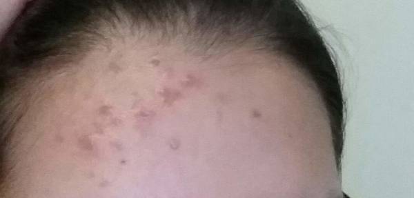 comment oublier son acné